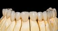Dental ceramic bridge Royalty Free Stock Photo
