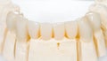Dental ceramic bridge Royalty Free Stock Photo