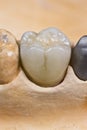 dental ceramic crown Royalty Free Stock Photo