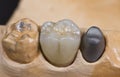 dental ceramic crown Royalty Free Stock Photo