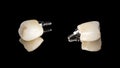 Dental ceramic molar crown on the implant. View from different sides, isolated on a black background. artificial human tooth