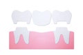 Dental crown with bridge, installation process and change of teeth Royalty Free Stock Photo