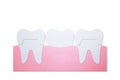 Dental crown with bridge, installation process and change of teeth Royalty Free Stock Photo