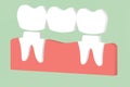 Dental crown with bridge, installation process and change of teeth Royalty Free Stock Photo
