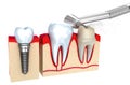 Dental crown , implant and teeth