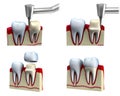 Dental crown installation process