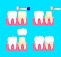 Dental crown installation process. Royalty Free Stock Photo