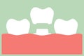 Dental crown, installation process and change of teeth Royalty Free Stock Photo