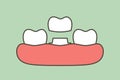 Dental crown, installation process and change of teeth Royalty Free Stock Photo