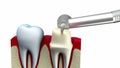 Dental crown installation process