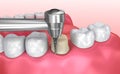 Dental crown installation process Royalty Free Stock Photo