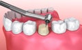 Dental crown installation process