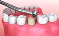 Dental crown installation process Royalty Free Stock Photo