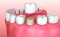 Dental crown installation process Royalty Free Stock Photo