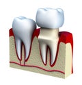 Dental crown installation process, isolated on white