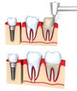 Dental crown installation process, isolated Royalty Free Stock Photo