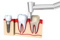 Dental crown installation process Royalty Free Stock Photo