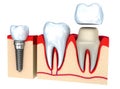 Dental crown installation process Royalty Free Stock Photo