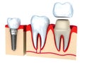 Dental crown installation process