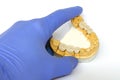 Dental crowns and bridges on the teeth of the lower jaw. dental prosthetics concept. replacement and prosthetics of missing teeth Royalty Free Stock Photo