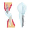 Dental crowns and implantation