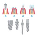 Dental crowns and implantation