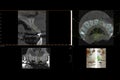 Dental 3D X-Ray of tooth implant.