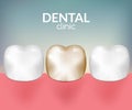 Dental desease clinic concept. Tooth healthcare hygiene. Toothache need dentist