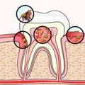 Dental diseases