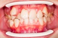 Dental displacement