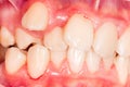 Dental displacement