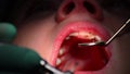 Dental drill is driling caries from teeth