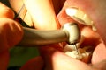 Dental drill and fixation tampons during stomatology procedure