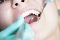 Dental drilling procedure on beautiful white denture Royalty Free Stock Photo