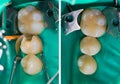 Dental filling comparison, before - after