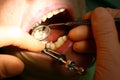 Dental filling, clamp and mouth mirror in action