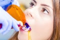 Dental filling procedure Royalty Free Stock Photo