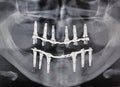 Dental guided surgery Royalty Free Stock Photo