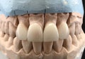 Dental gypsum model in dentist laboratory office - close-up. Gypsum Dentures with porcelain teeth isolated on black background. Royalty Free Stock Photo