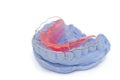 Dental gypsum models and dental brace