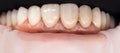 Dental health care. Ceramic zirconium in final version. Precision design and high quality materials. Zirconia bridge Royalty Free Stock Photo