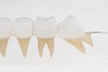 Dental impacted tooth inflammation Royalty Free Stock Photo