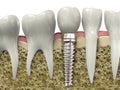 Zubní implantát 