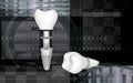 Dental implant