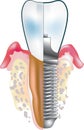 Dental implant