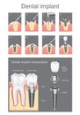 Dental implant. Royalty Free Stock Photo