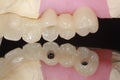 A dental implant bridge with reflection of occlusal hole Royalty Free Stock Photo