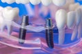 Dental implant bridge screws in human jaw teeth model Royalty Free Stock Photo