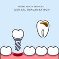 Dental implant instead of carious tooth - teeth prosthetics Royalty Free Stock Photo