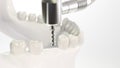 Dental implant on the example of a jaw model - 3D rendering Royalty Free Stock Photo